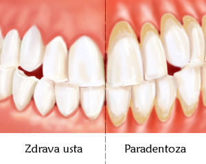 paradentoza lecenje